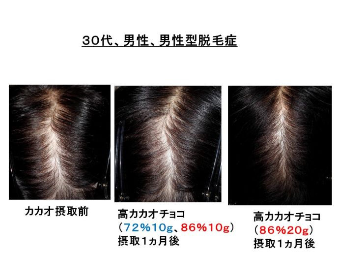 円形脱毛症　病院